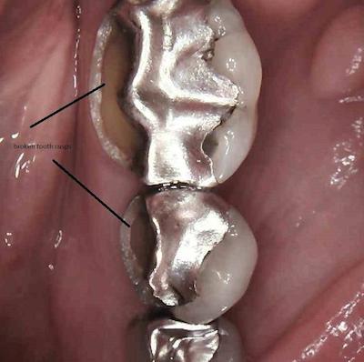 Fractured Tooth Cusps And Old amalgam Fillings