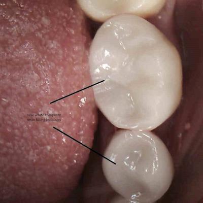 Amalgam Removed And Tooth Restored With Composite Resin An Alternative to Placing A Porcelain Or Gold Crown