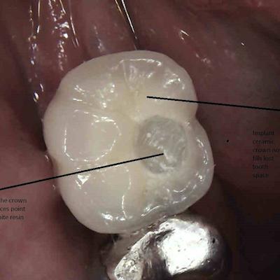 B2 Implant Retained Crown Fitted Into Lower Right First Molar Space