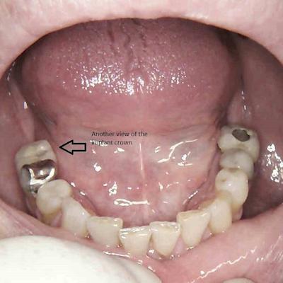 B3 Lower Right First Molar Implant Crown