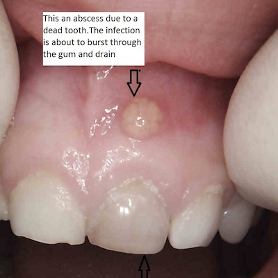 Trauma to Baby Tooth