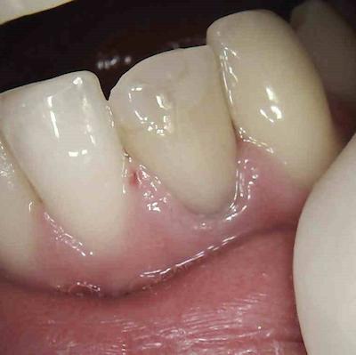 C1Bleaching Of Teeth,This Root Treated Tooth Started To Discolour ,Internalbleachingor Whiteneing Was Done And New White Filling Material Placed Seephoto C2