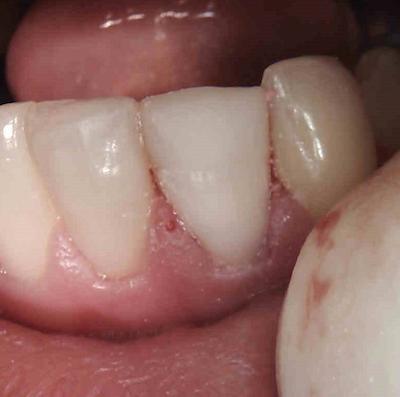 Bleached root canal tooth and new white filling