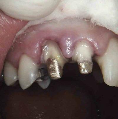 The two teeth are built up with gold posts after root canal