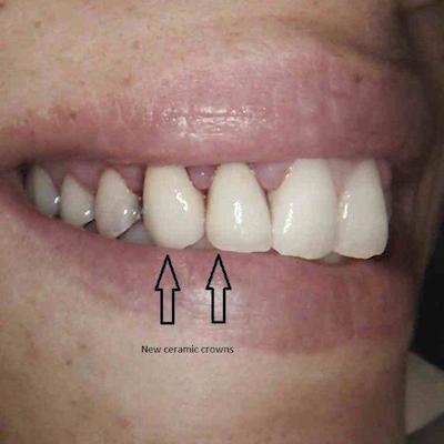 Two ceramic crowns are then cemented over the gold posts. With improved home cleaning the swollen gums will form a better shape