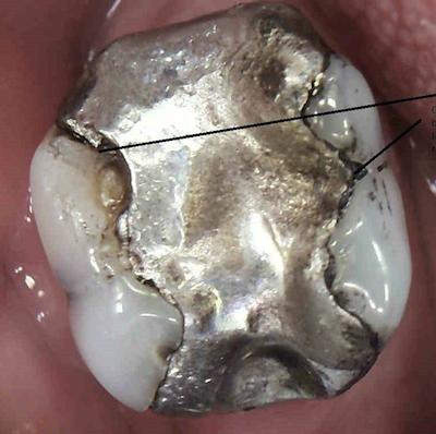 Failing amalgam filling see the gaps between the tooth and black metal filling. This tooth would eventually split and decay.