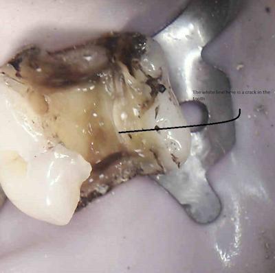 The filling has been removed safely under rubber dam you can now see the damaged stained tooth that was under the failing filling