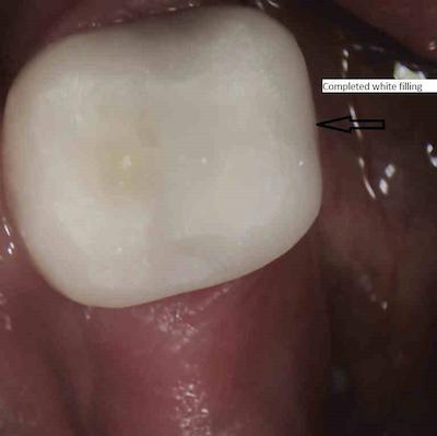 tooth has now been restored with white composite resin filling materialas an alternative to a porcelain or gold crown