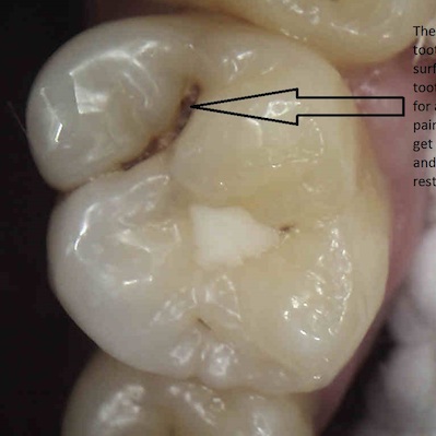 Occlusal Decay